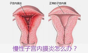 慢性子宫内膜炎