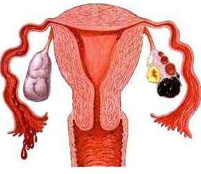 卵巢性不孕